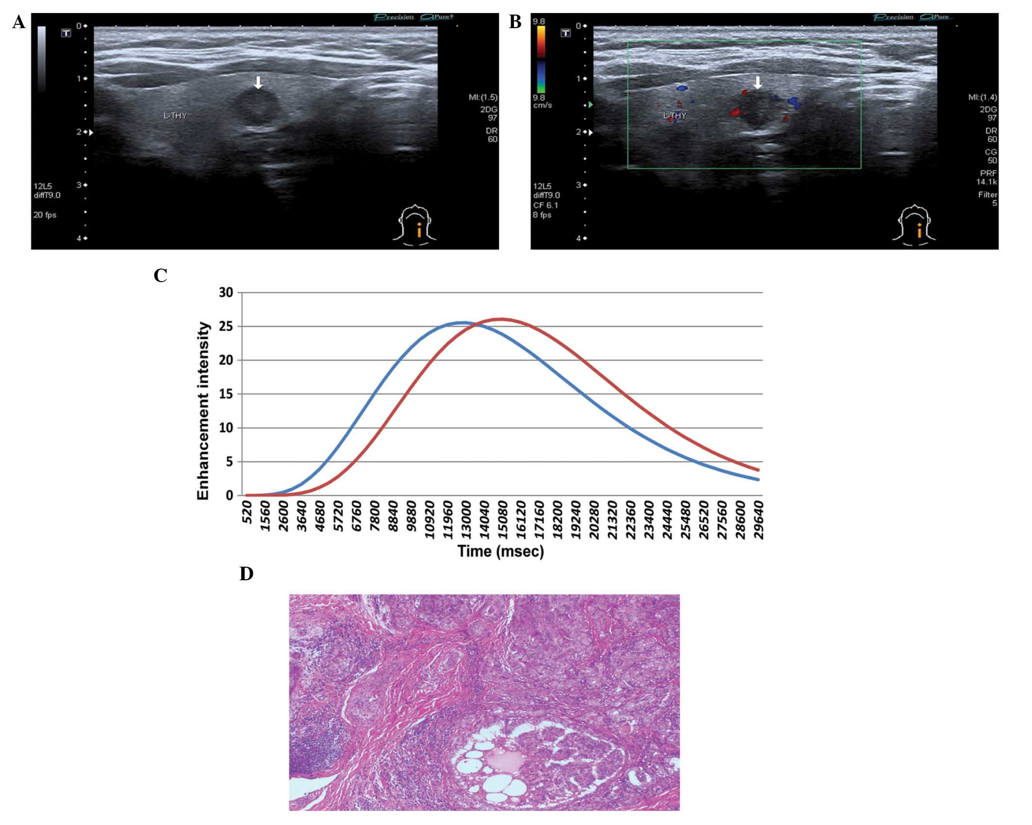 Diagnostic Value Of Contrast‑enhanced Ultrasound In Papillary Thyroid