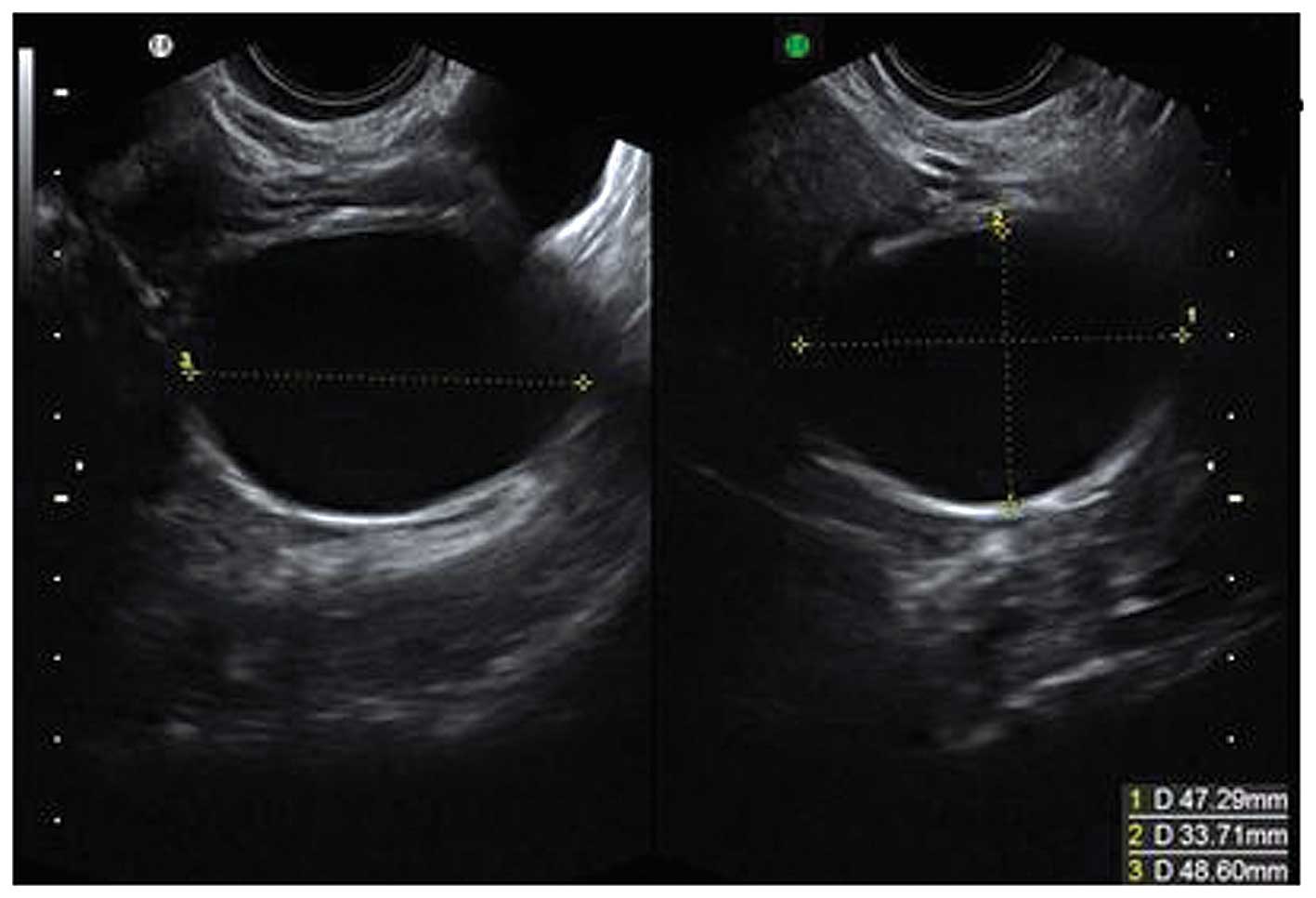 Ovarian Cancer Ultrasound Ovarian Cyst Transvaginal Ultrasonography