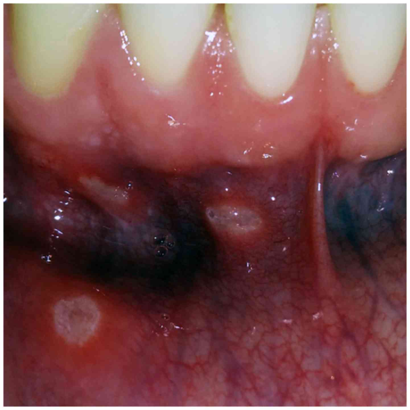 Essentials Of Recurrent Aphthous Stomatitis Review 