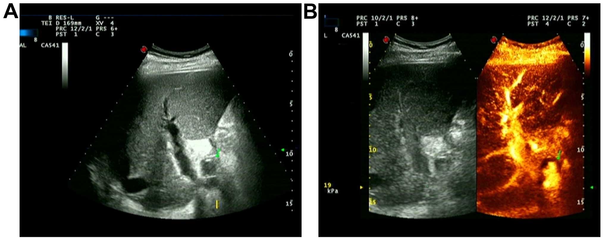 Common ultrasound and contrast-enhanced ultrasonography in the