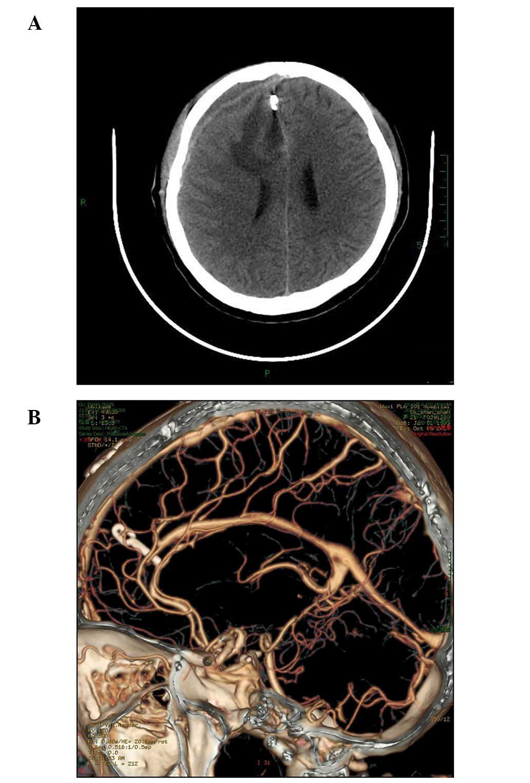 Treatment Of A Giant Arteriovenous Malformation Associated With Intracranial Aneurysm Rupture