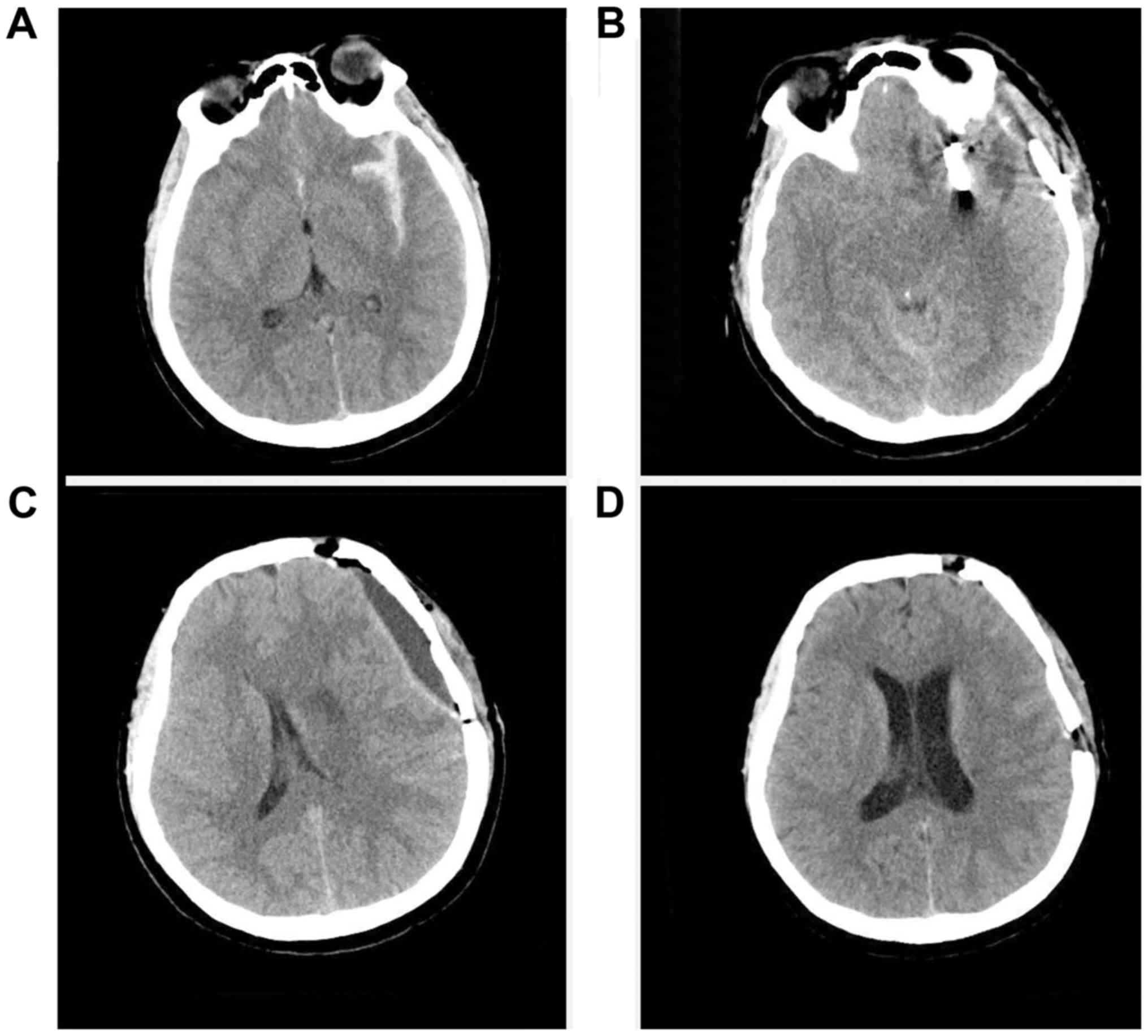 Early post‑operative cerebrospinal fluid hypovolemia: Report of 7 cases