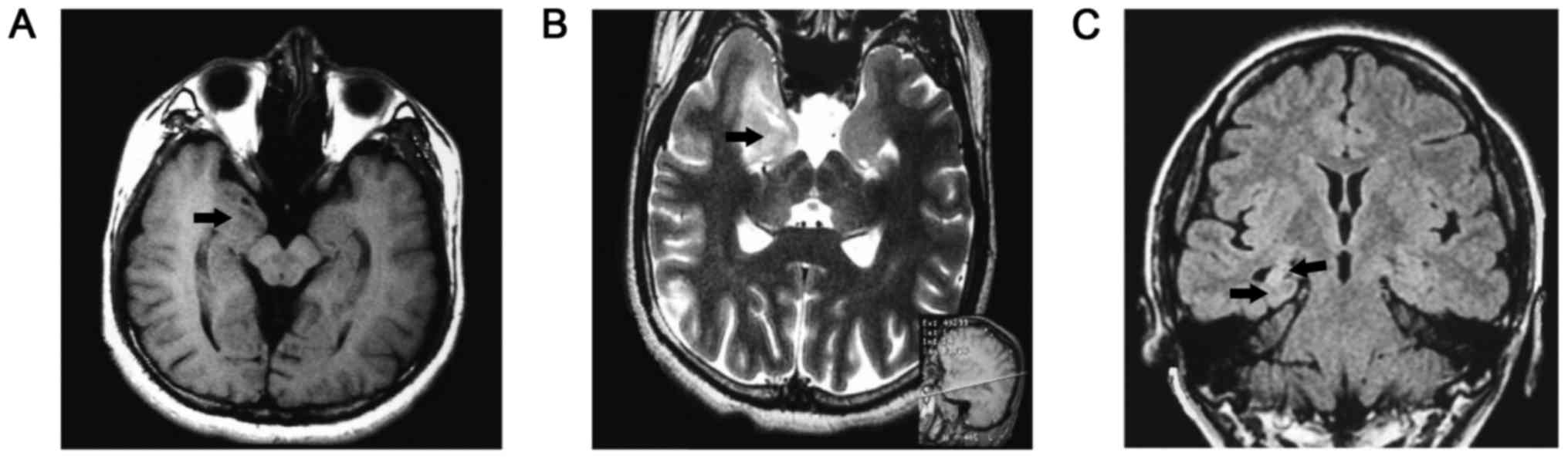Temporal Lobe Epilepsy In Patients With Nonlesional Mri