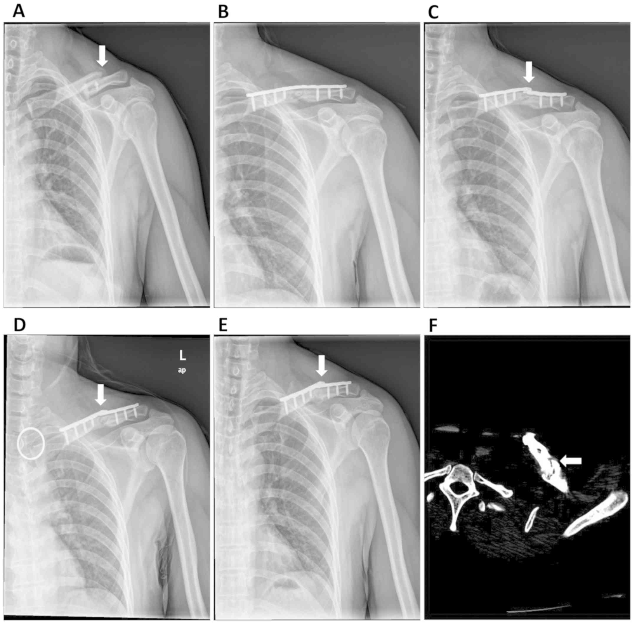 Clavicle Fracture Xray