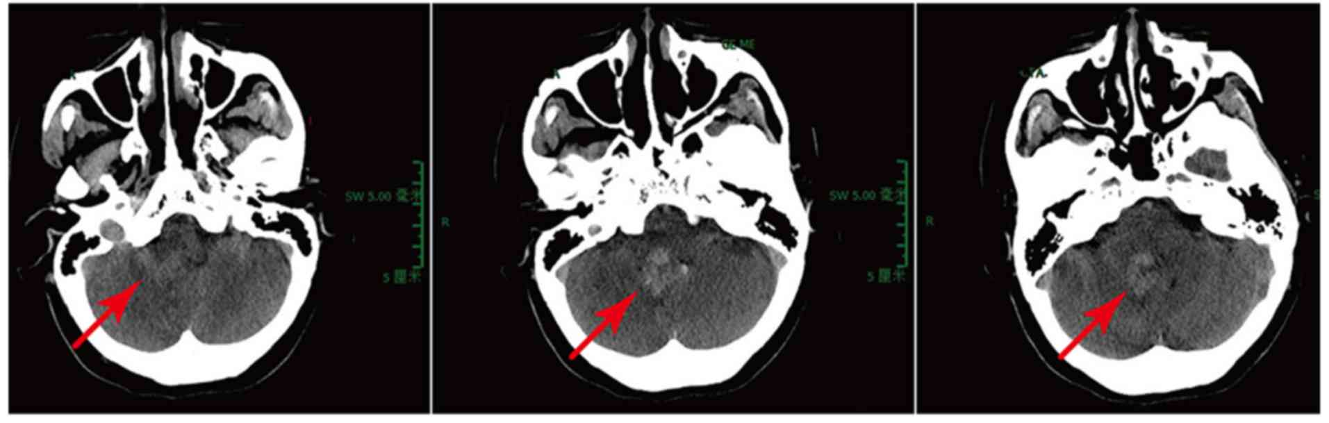 Treatment of a giant complicated distal posterior inferior cerebellar ...