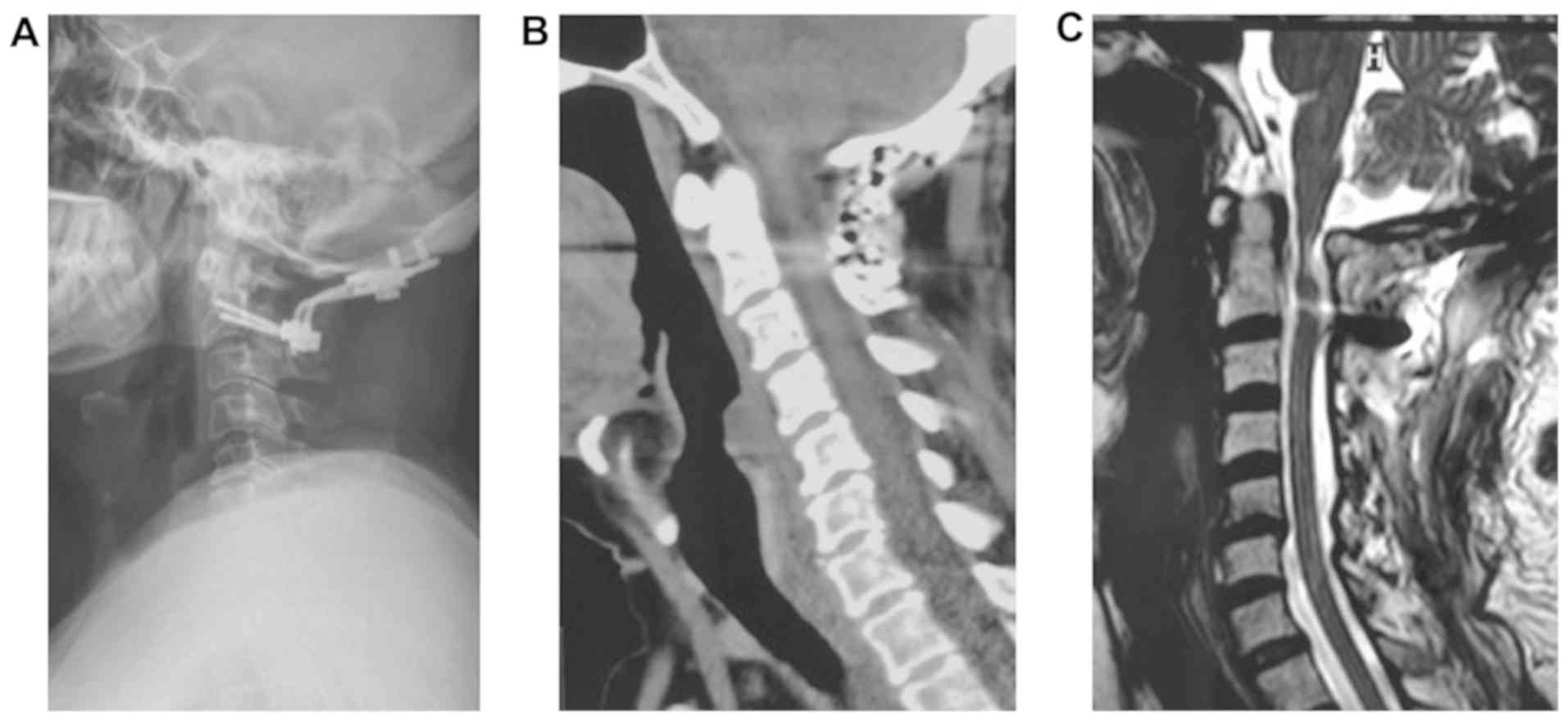 Ossification Of The Ligamentum Flavum In The Upper Cervical Spine A Report Of Two Cases And Literature Review