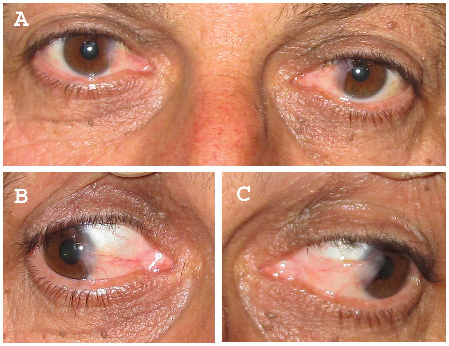 pterygium eye disease