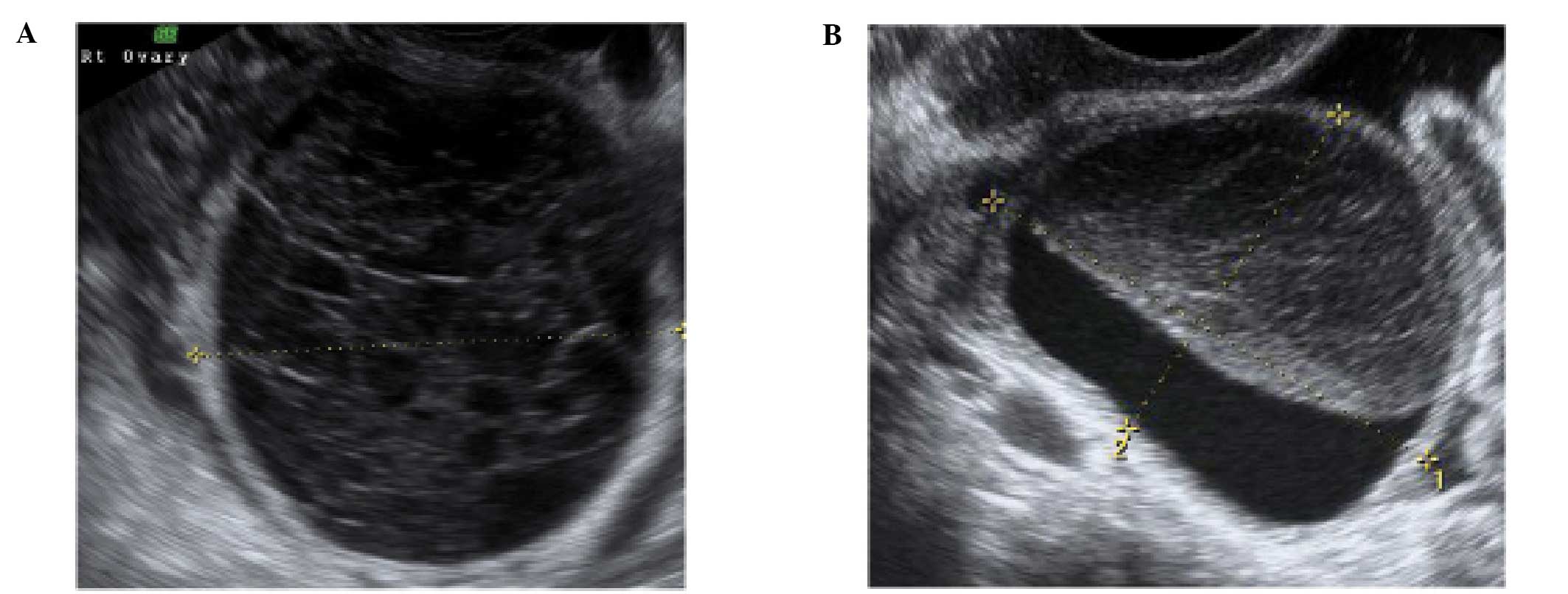 The Characteristic Ultrasound Features Of Specific Types Of Ovarian 