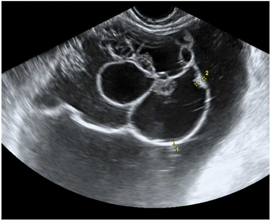 The Characteristic Ultrasound Features Of Specific Types Of Ovarian 