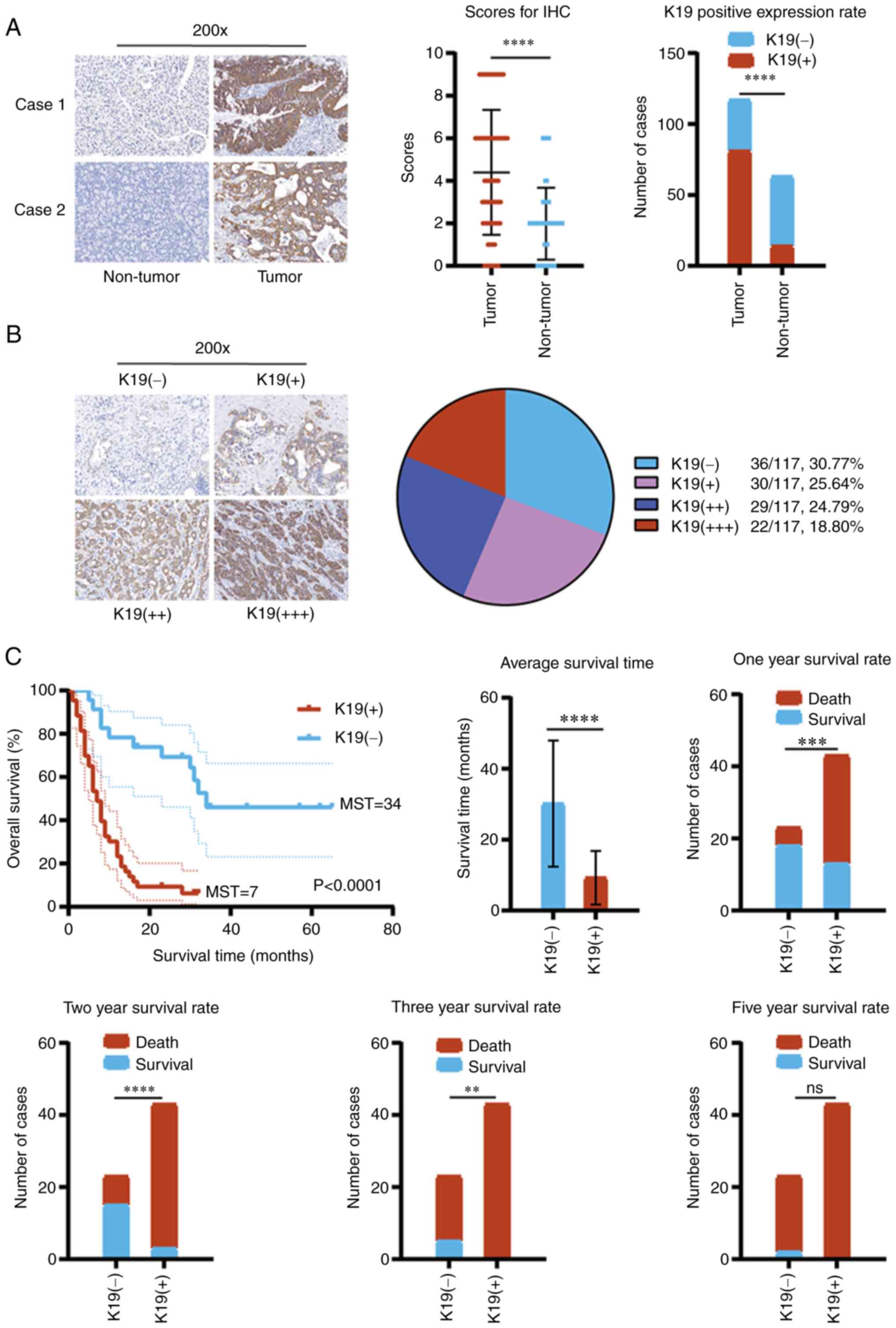 Keratin19 Promotes Pancreatic Cancer Progression And Poor Prognosis Via