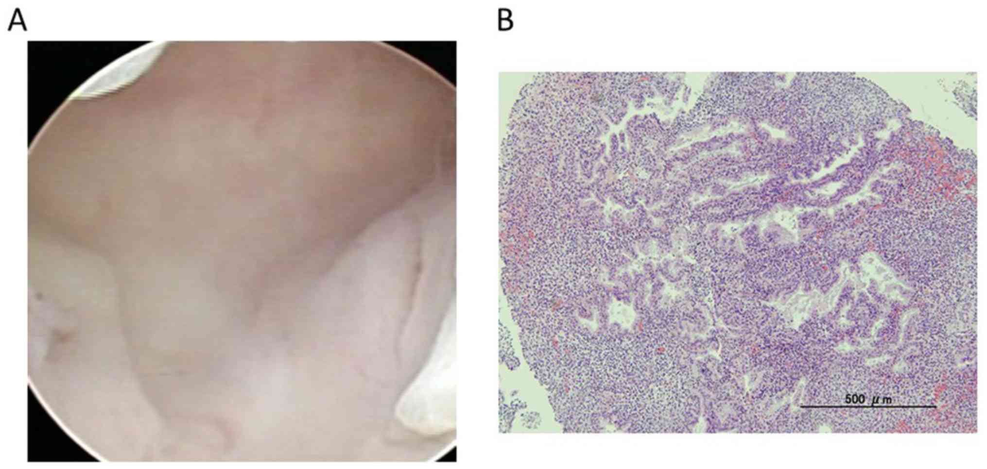 Hysteroscopy Endometrial Cancer