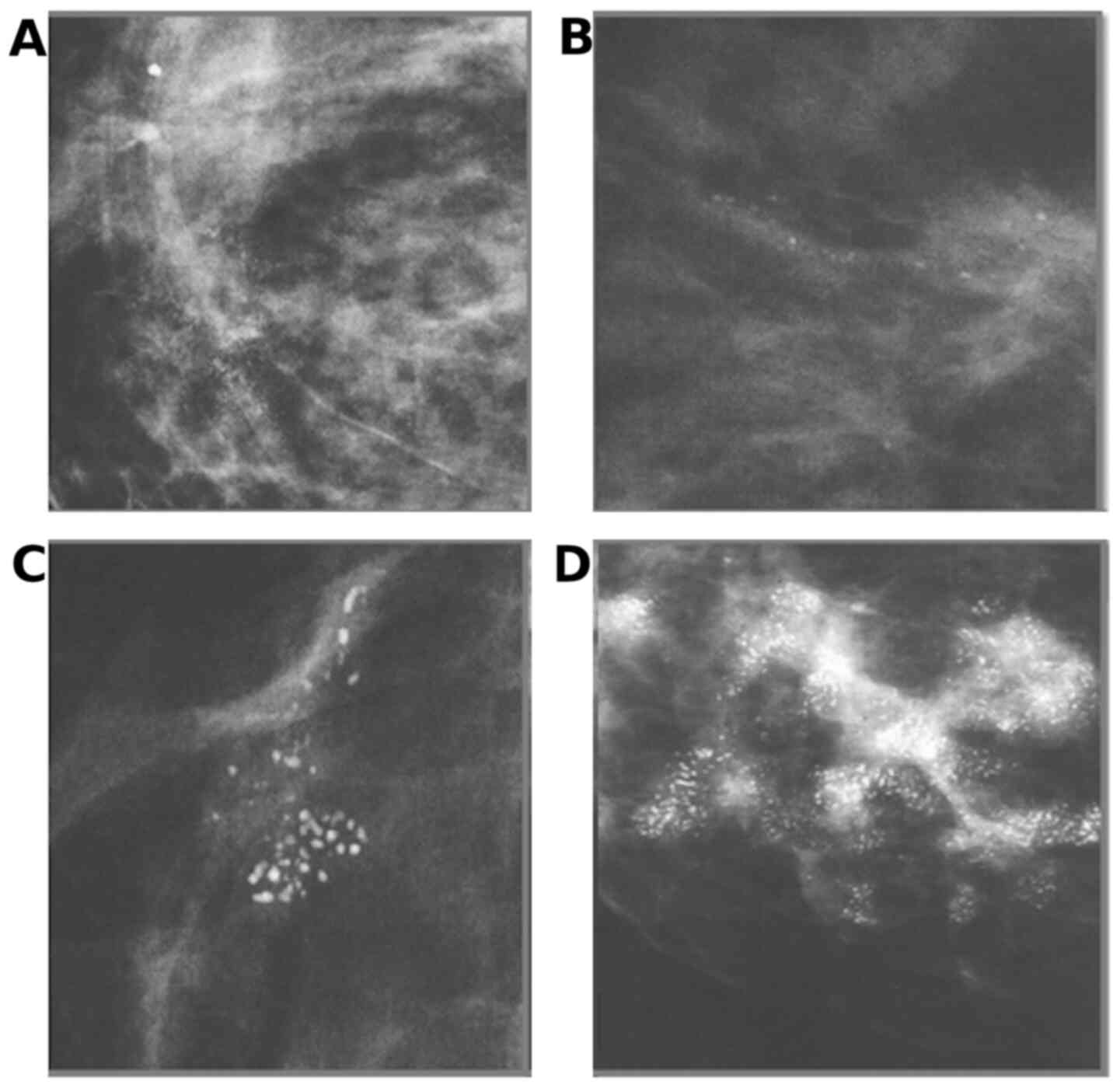 Breast Microcalcifications Past Present And Future Review