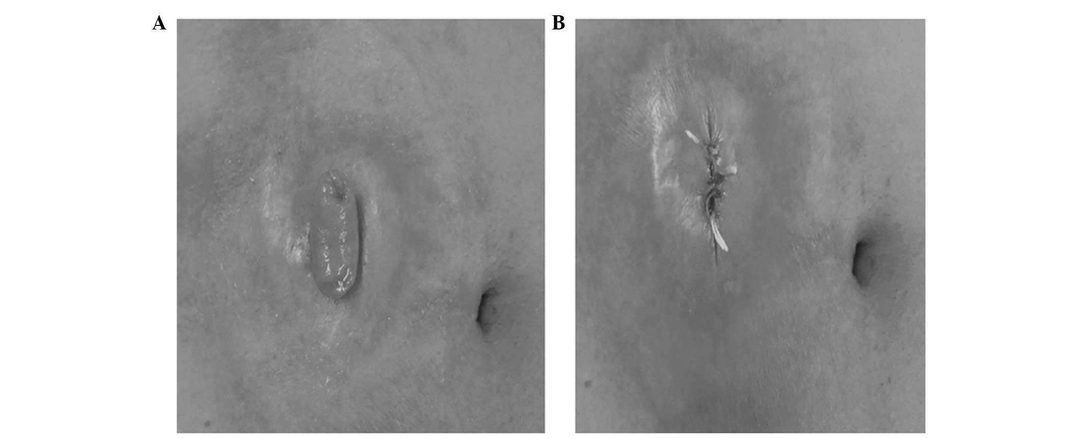 Purse String Suture Closure: A Useful Double-Layer Technique for Closure of  an Oronasal Communication | Journal of Maxillofacial and Oral Surgery