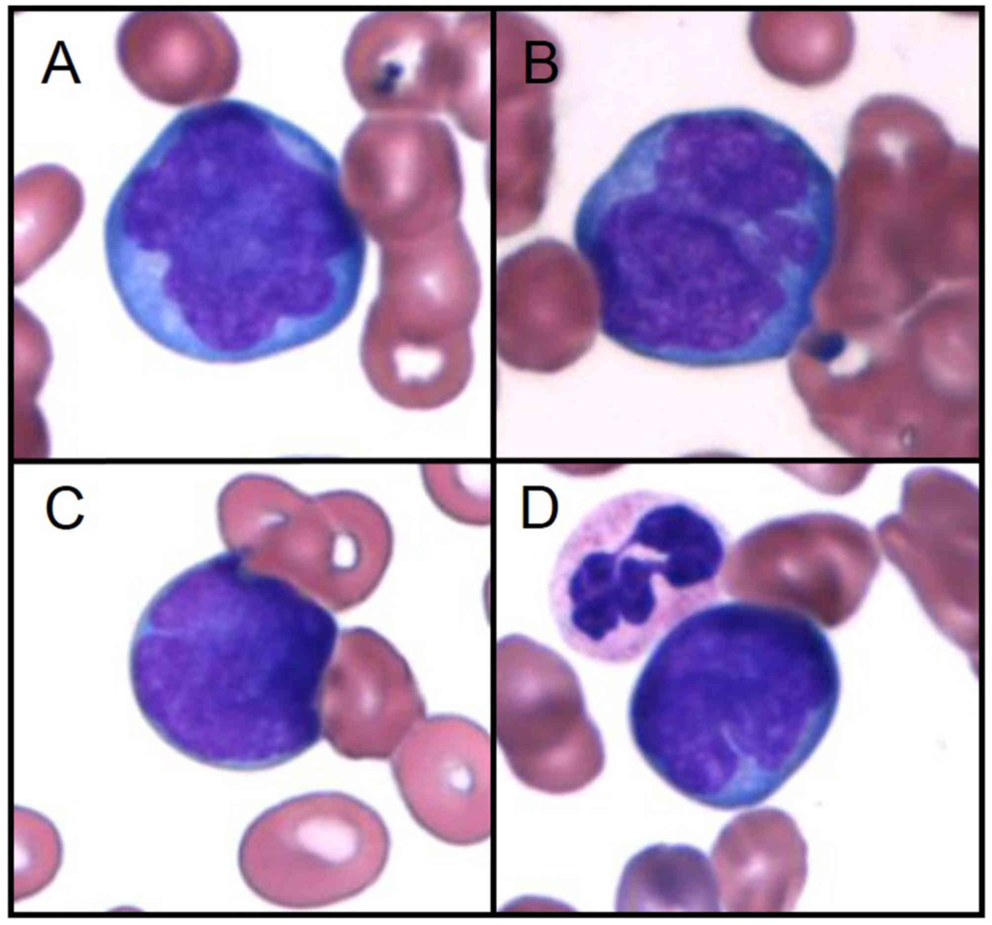 Efficacy Of Bendamustine On Thrombocytopenia And Hemolytic Anemia
