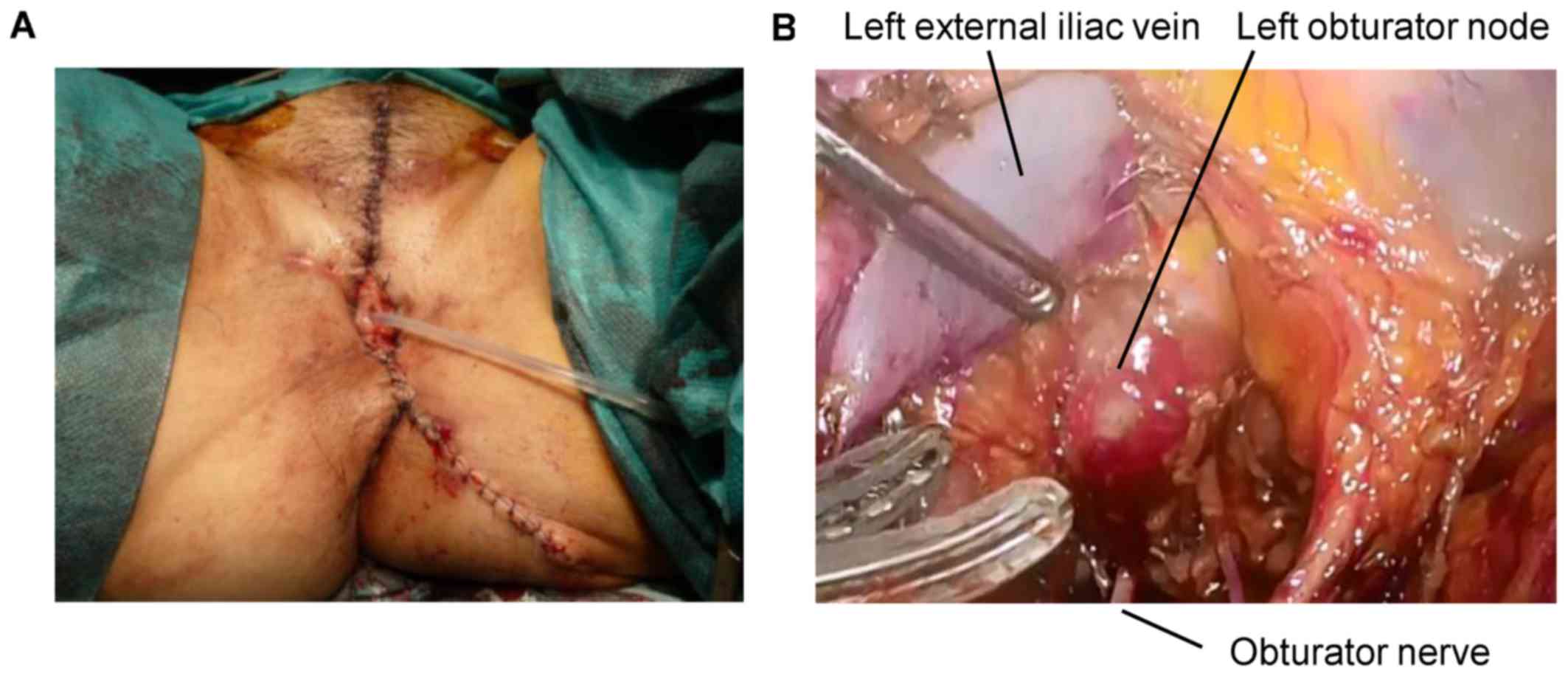 Vulvectomy surgery photos