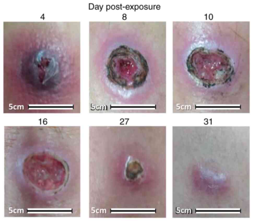 Topical potassium permanganate solution use in dermatology