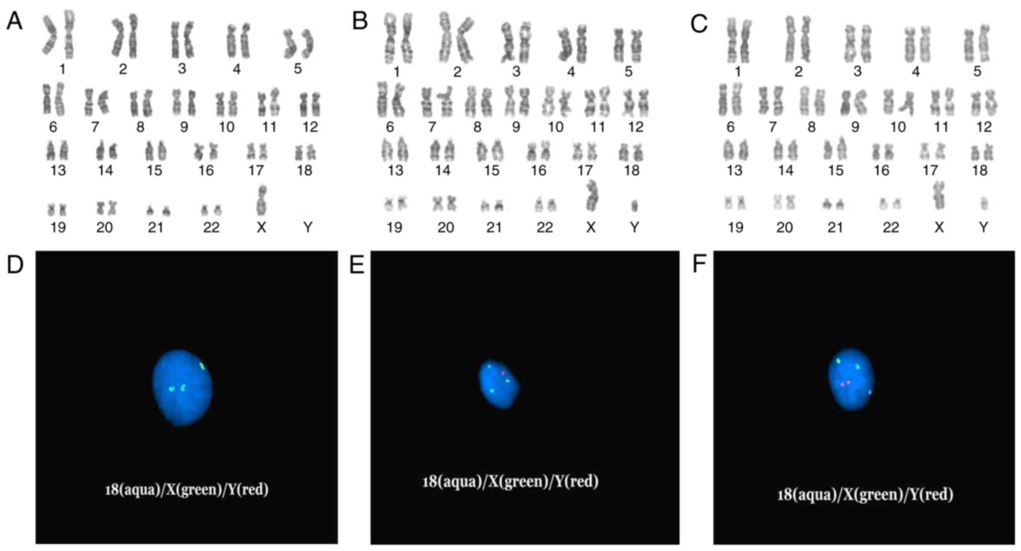 Prenatal Diagnosis Of Sex Chromosome Mosaicism With Two Marker