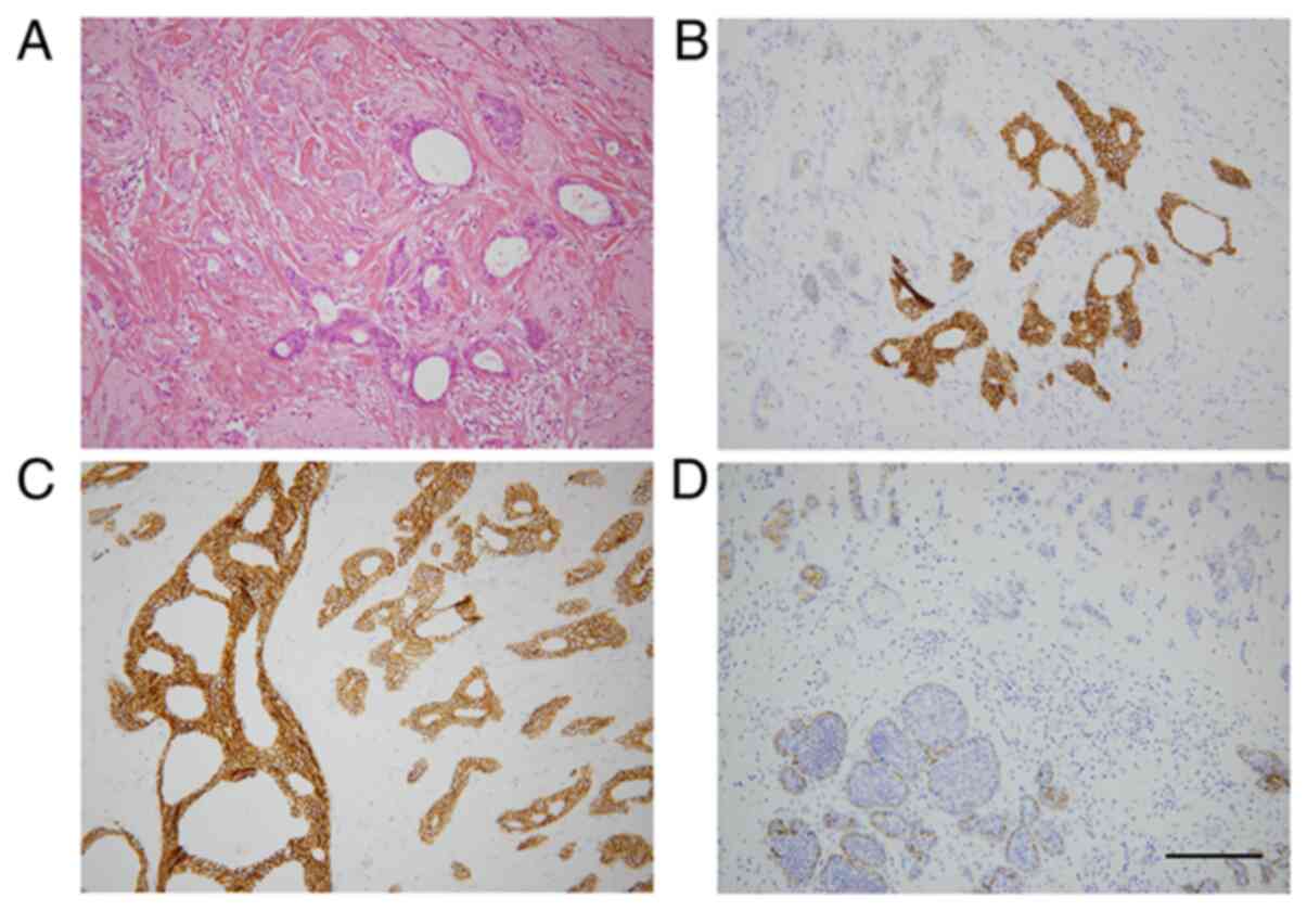 Phylogenetic Analysis Of Combined Lobular And Ductal Carcinoma Of The 