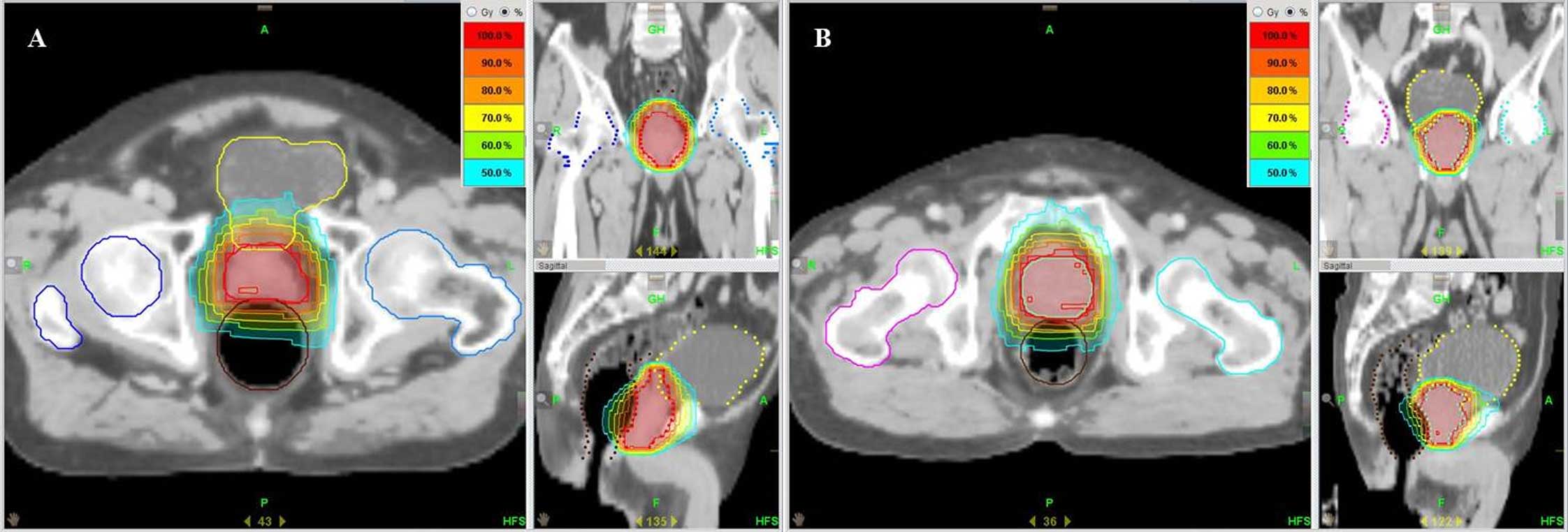 Salvage helical tomotherapy for prostate cancer recurrence