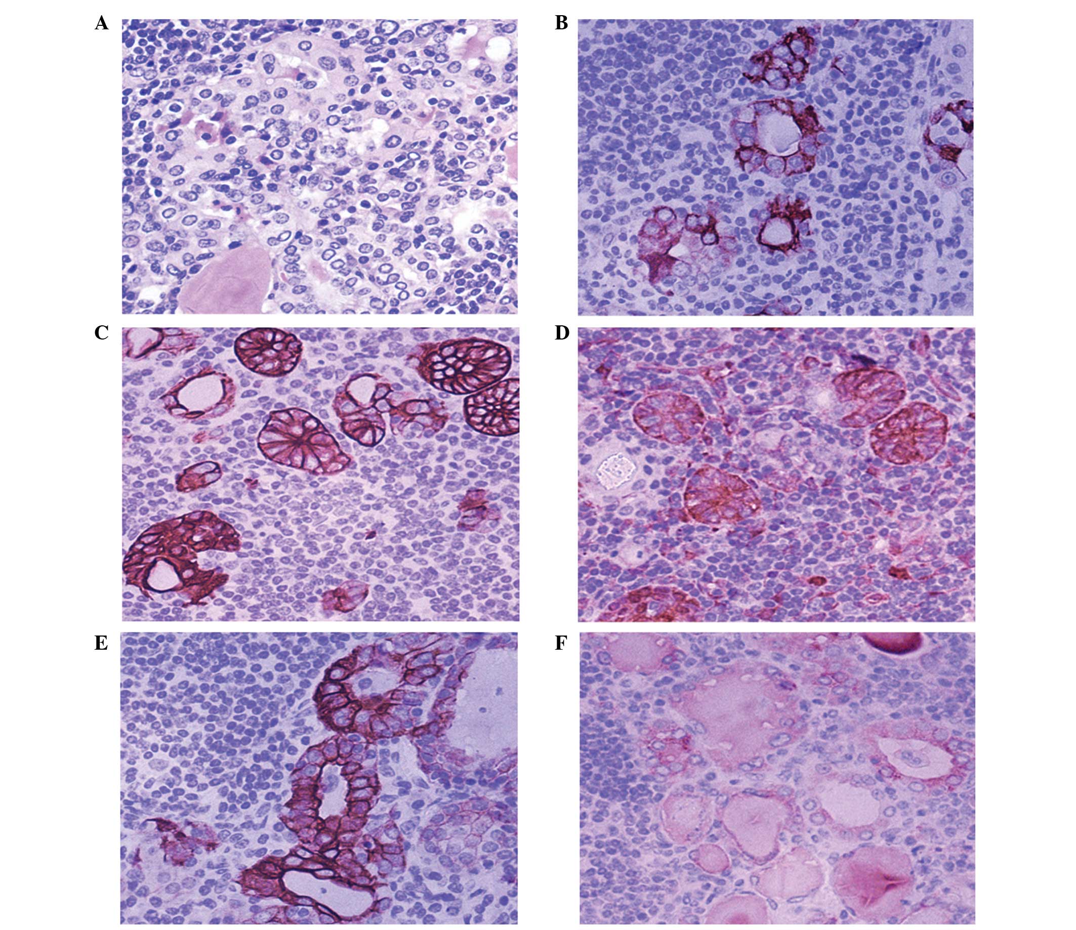 Intercellular Adhesion Molecule 1 Is A Sensitive And Diagnostically Useful Immunohistochemical Marker Of Papillary Thyroid Cancer Ptc And Of Ptc Like Nuclear Alterations In Hashimoto S Thyroiditis
