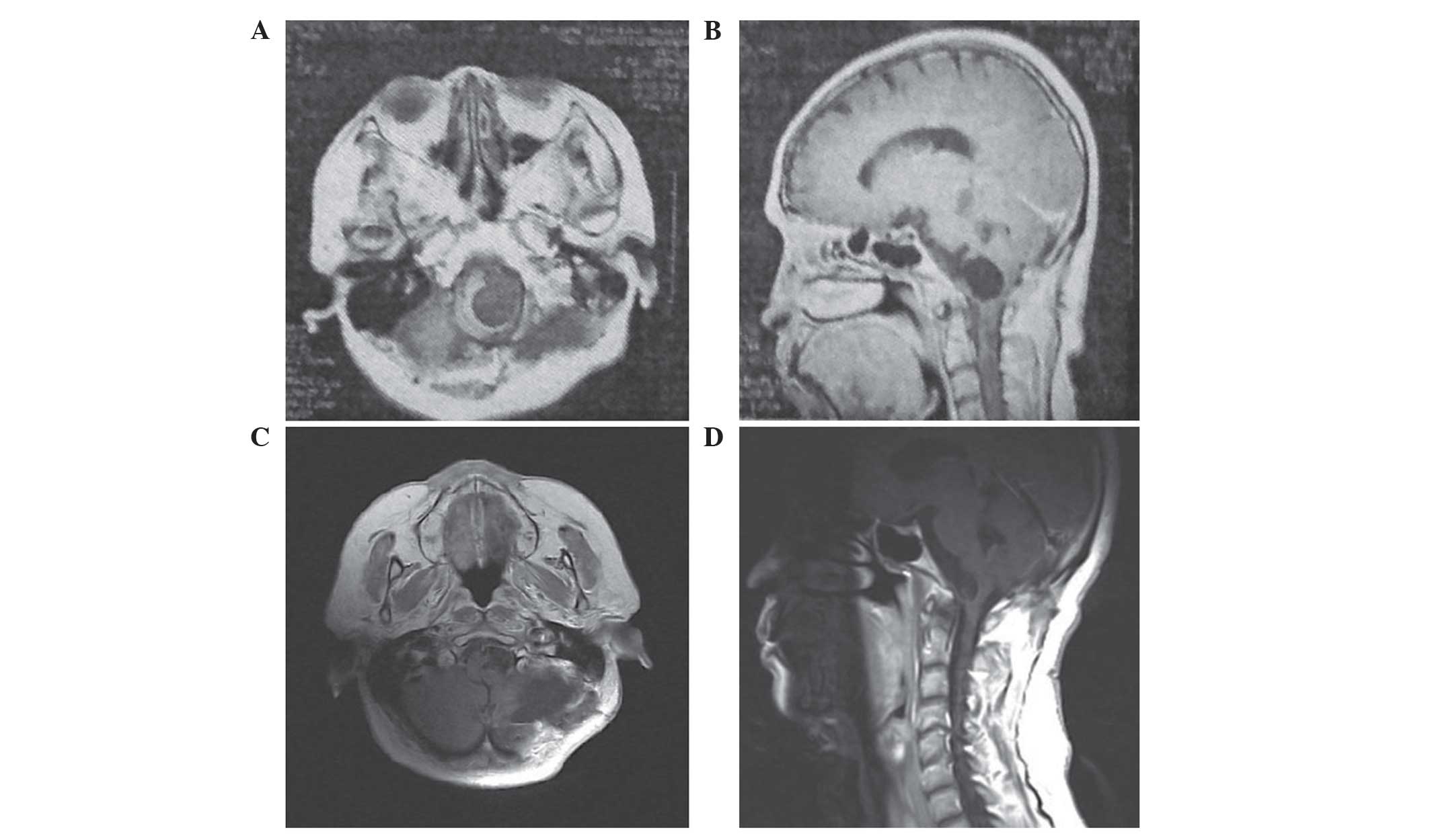 Double intraspinal enterogenous cysts.