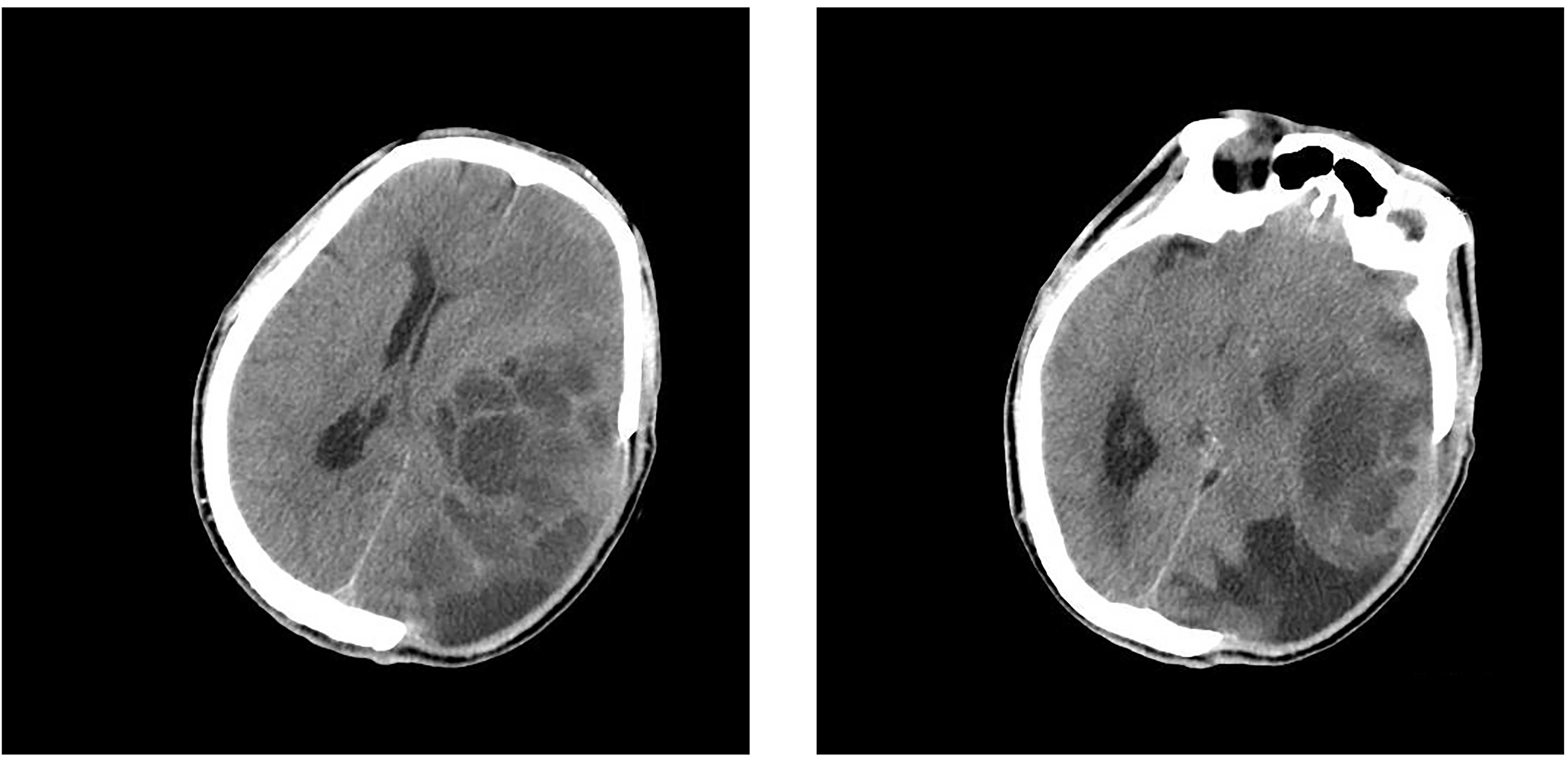 Rapid Progression Of Glioblastoma Multiforme A Case Report