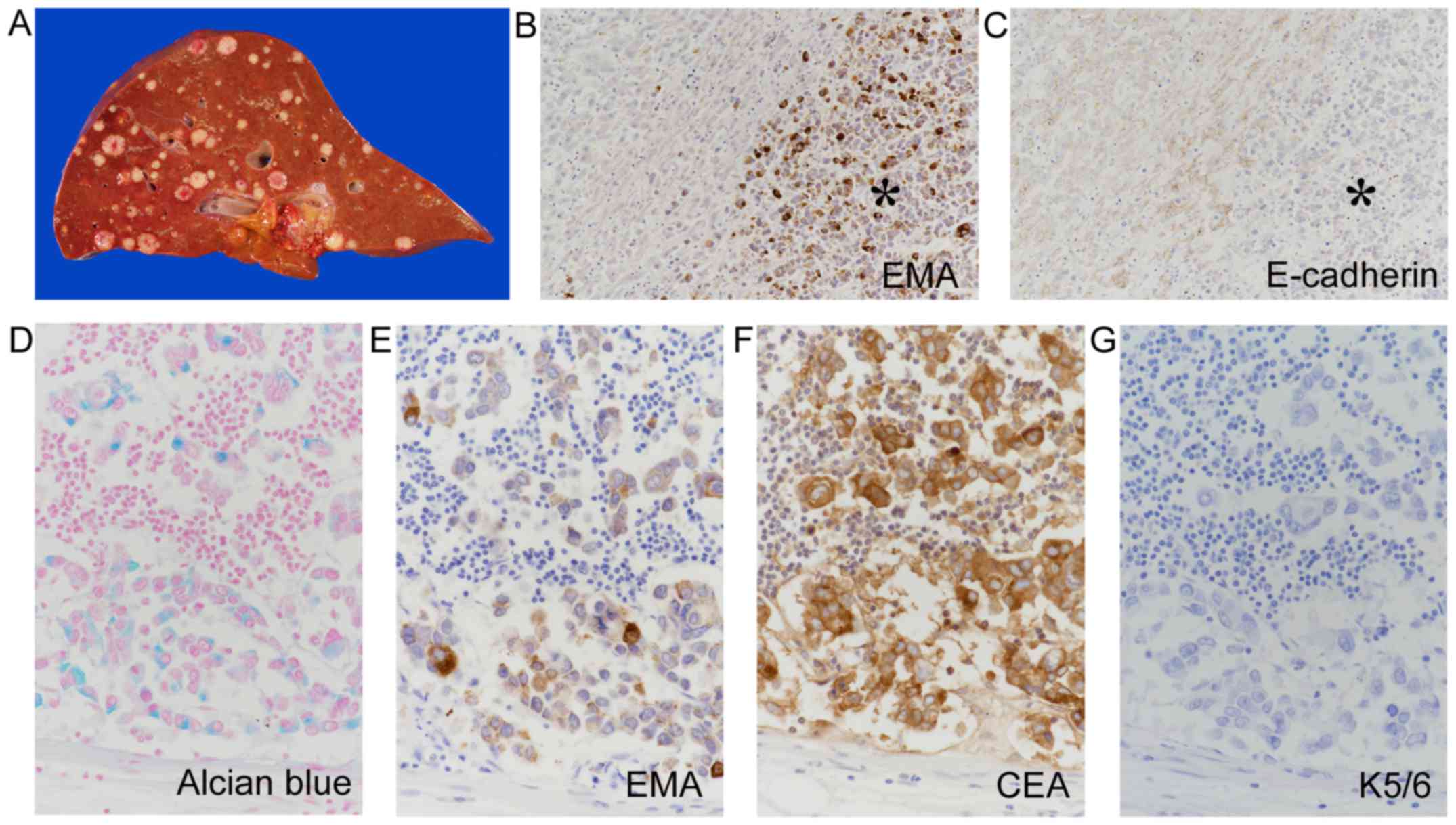 Esophageal adenosquamous carcinoma mimicking acantholytic squamous cell ...