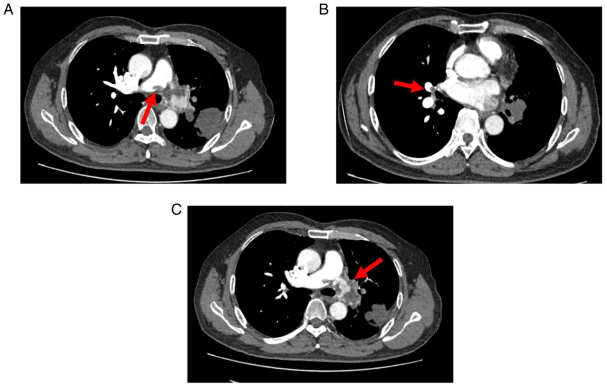 An intimal sarcoma of pulmonary artery mimicking pulmonary