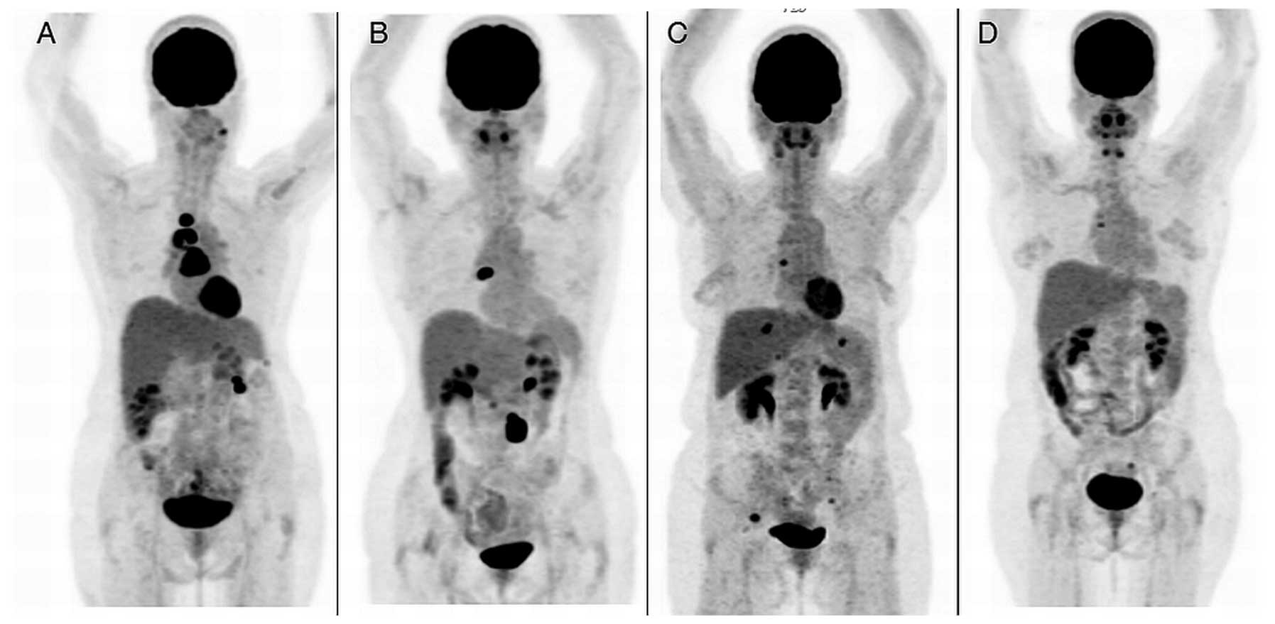 Staging Recurrent Ovarian Cancer With 18FDG PET CT