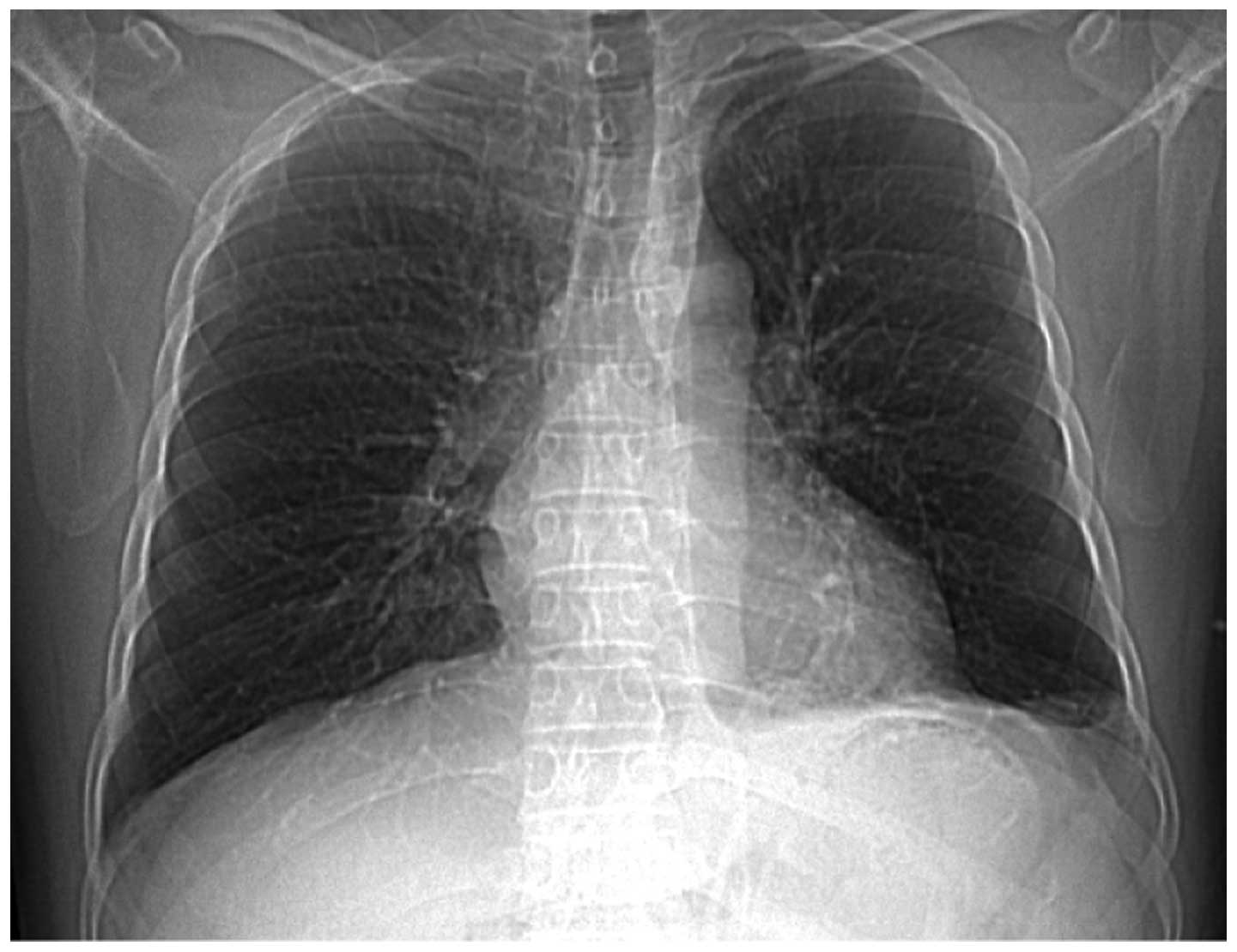 Pulmonary sequestration presenting with left upper abdominal bloating