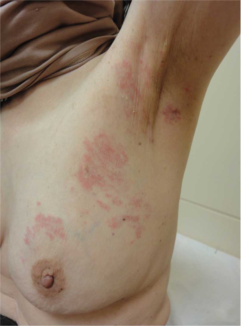 strep throat rash pictures on skin #11