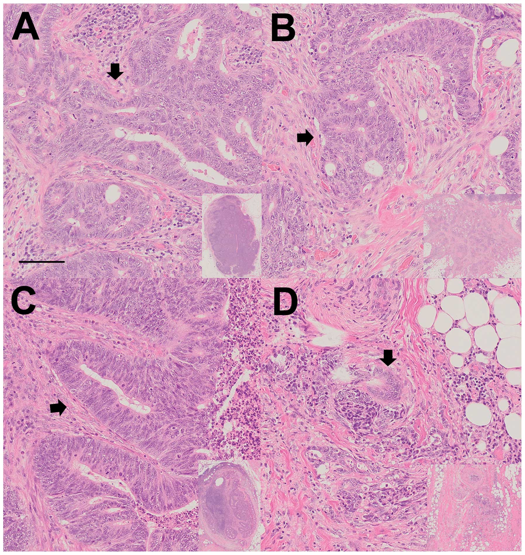 New enhanced and effective method for staging cancer to detect lymph ...